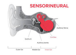 Audiogram Example