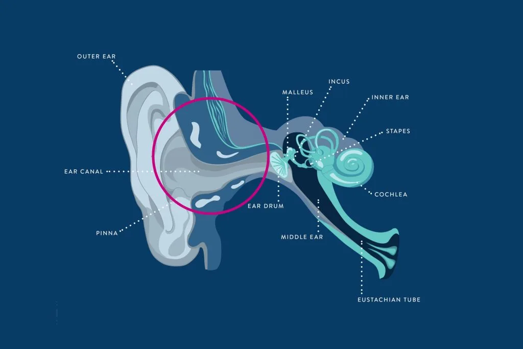 Conductive hearing loss ear diagram showing blockage in outer and middle ear