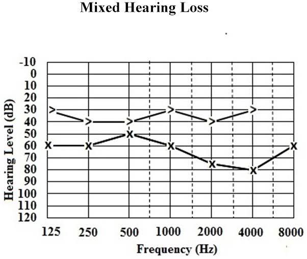Audiogram Example